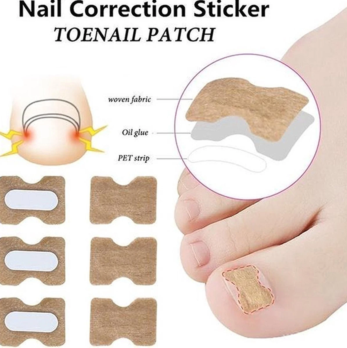 Teennagel Lifter I Ingegroeide Teennagel Corrector I Teennagel Pleister I Anti Ingroei Pleister I Nagel Correctie Kit I 30 Stuk 1 Teennagel Lifter I Ingegroeide Teennagel Corrector I Teennagel Pleister I Anti Ingroei Pleister I Nagel Correctie Kit I 30 Stuk