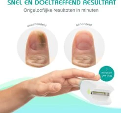 Anti Schimmelnagel Zelf-laserapparaat Incl. Pedicure Set 13 Anti Schimmelnagel Zelf-laserapparaat Incl. Pedicure Set -Verzorgingsproducten 1200x1120 2