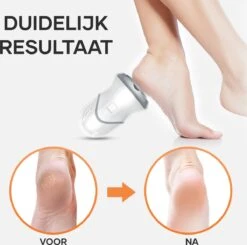 MW® Elektrische Eeltverwijderaar - Voetvijl - Eelt Verwijderaar - Elektrische Vijl - 3 Vijlschijven -Verzorgingsproducten 1200x1191 2