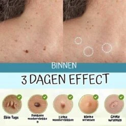 Skini™ - Moedervlekken & Wratten & Skin Tags Verwijderaar | Moedervlekken Verwijderaar | Wratten Verwijderaar | Moedervlekken Verwijderen | Wratten Verwijderen | Fibroom Verwijderen | Skin Tag Verwijderen | Steelwratjes Verwijderen 5 Skini™ - Moedervlekken & Wratten & Skin Tags Verwijderaar | Moedervlekken Verwijderaar | Wratten Verwijderaar | Moedervlekken Verwijderen | Wratten Verwijderen | Fibroom Verwijderen | Skin Tag Verwijderen | Steelwratjes Verwijderen -Verzorgingsproducten 1200x1200 180