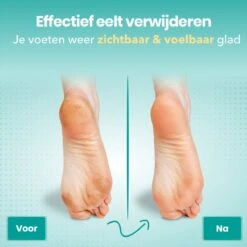 FreshDragon Elektrische Eelt Verwijderaar - Voetvijl - Inclusief 3 Rollers - Oplaadbaar -Verzorgingsproducten 1200x1200 752