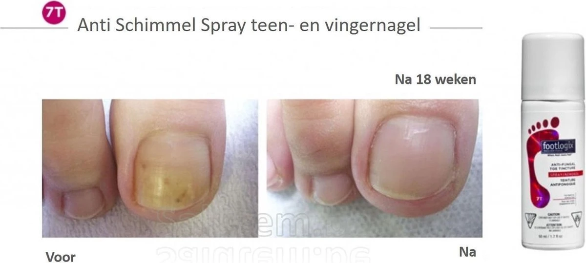 Footlogix Toe Nail Tincture Nagelspray 2 Footlogix Toe Nail Tincture Nagelspray - Afbeelding 2