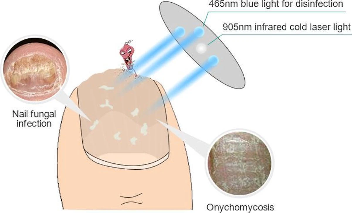 Anti Schimmelnagel Kalknagel Laserapparaat Om Zelf Te Behandelen, Veilig, Effectief, Snel En Pijnloos, Koude Laser Behandeling Voor Thuisgebruik, Voor Tenen En Vingers. Oplaadbaar. 2 Anti Schimmelnagel Kalknagel Laserapparaat Om Zelf Te Behandelen, Veilig, Effectief, Snel En Pijnloos, Koude Laser Behandeling Voor Thuisgebruik, Voor Tenen En Vingers. Oplaadbaar. - Afbeelding 2