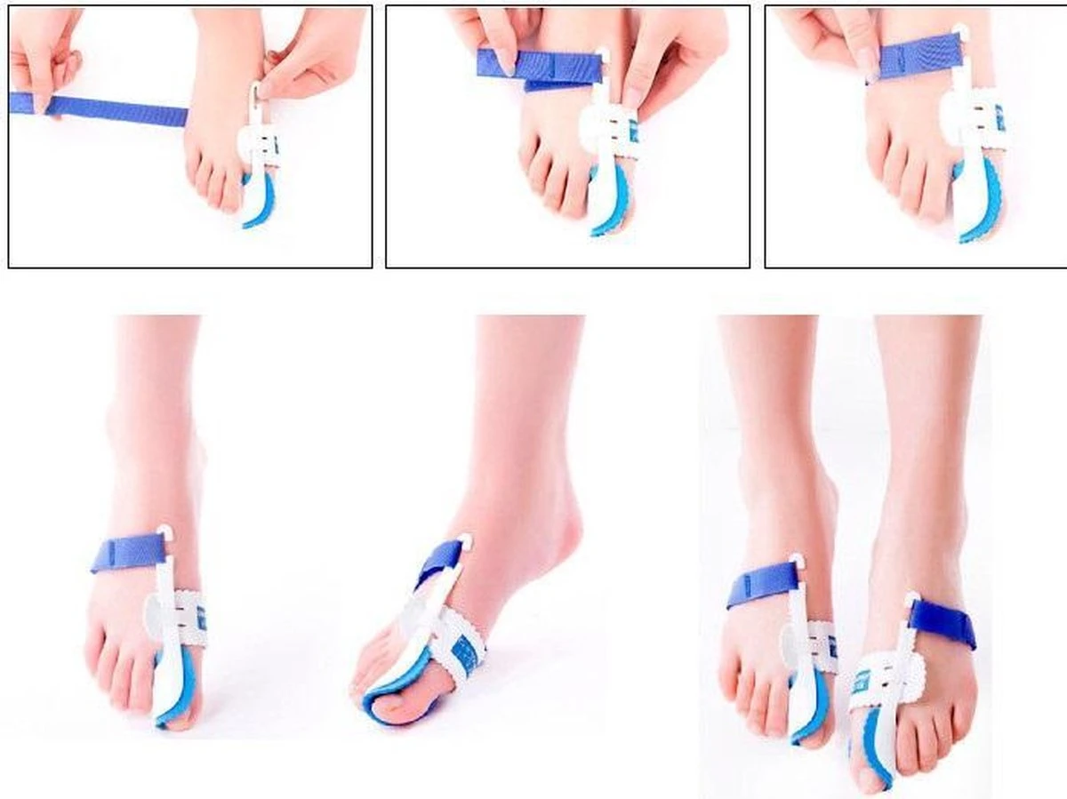 Hallux Valgus Statische Nachtspalk - Rechts + Links - Foot Pijnbestrijding - Teen Separator - Duim Corrector - Blauw / Wit 4 Hallux Valgus Statische Nachtspalk - Rechts + Links - Foot Pijnbestrijding - Teen Separator - Duim Corrector - Blauw / Wit - Afbeelding 4