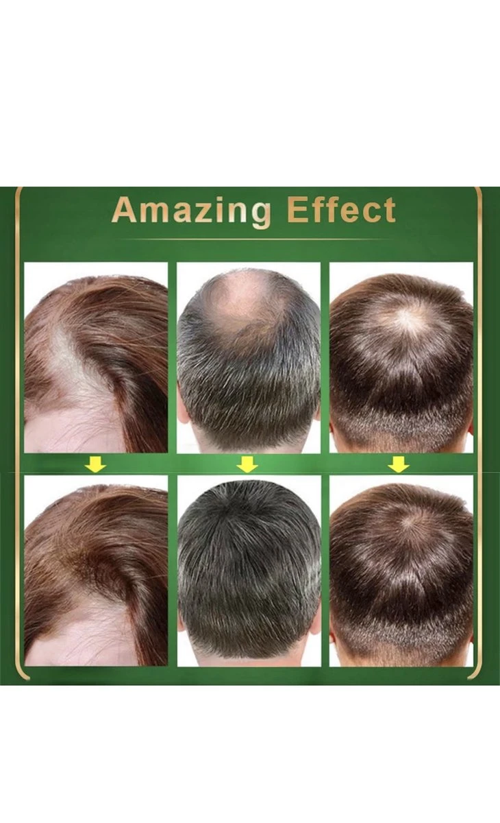 Green Wealth - Neo Hair Lotion Original - NEO HAIR Origineel - Haaruitval - Haargroeimiddel + GRATIS DERMAROLLER 2 Green Wealth - Neo Hair Lotion Original - NEO HAIR Origineel - Haaruitval - Haargroeimiddel + GRATIS DERMAROLLER - Afbeelding 2